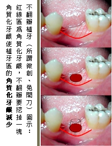 2020 09 21 solution of artificial dental implants 01